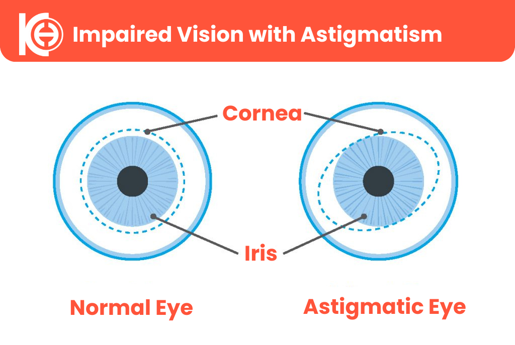 Астигматизм
